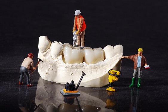 歯のブリッジの寿命はだいたい７年程度です。