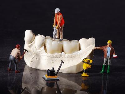歯科技工士がオススメする、前歯のインプラントに適しているクラウン