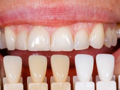 ホワイトニング中なのに歯が白くならない人が大逆転出来る３つのルール。