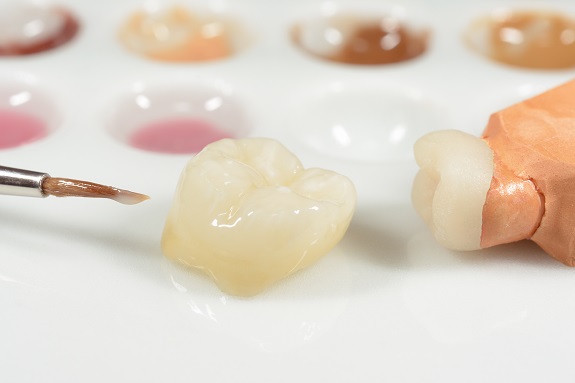 前歯の差し歯をセラミックにしようと考えているのですが、どういったものがオススメですか？
