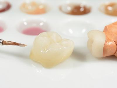 前歯の差し歯をセラミックにしようと考えているのですが、どういったものがオススメですか？