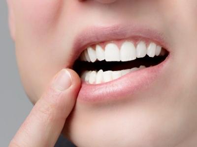 歯茎が白いと癌の前兆ってほんと？歯茎が白くなる８つの原因