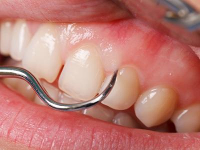が 痒い 歯茎 歯茎がかゆい：医師が考える原因と対処法｜症状辞典