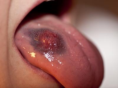 舌が黒いあなたが注意すべき病気と、その原因
