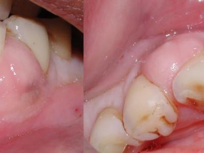歯のおでき、フィステル（内歯瘻、瘻孔）の正体と治療法を歯科医師が解説します。