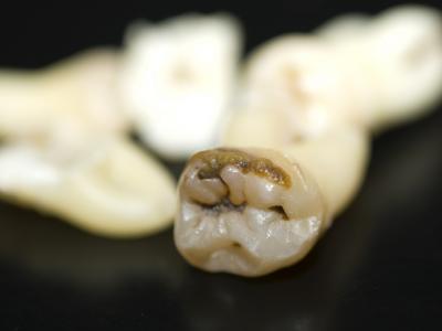 歯を削り、詰めて安心する日本人。しかし銀歯の下は虫歯菌まみれ。根本から違う日本人の虫歯の考え方。