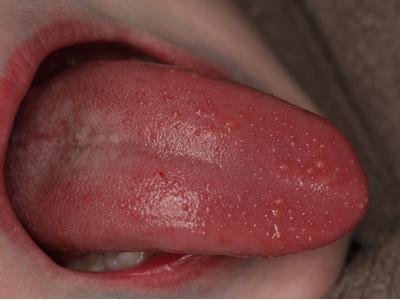 舌に血豆が突然できたけど、治し方はあるの？血豆がよく出来るのは癌ってホント？？