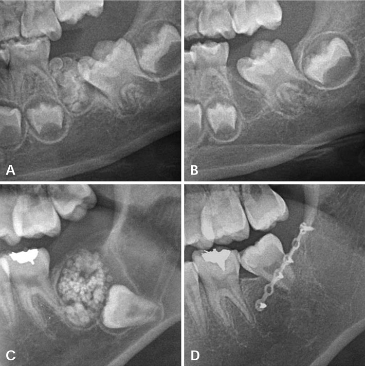 歯牙腫とは一体何？治療法から手術の流れまで完全解説。歯牙腫は良性腫瘍なので心配なさらず。