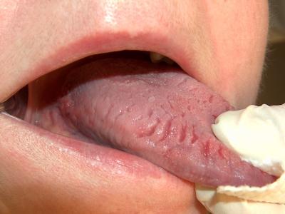 【画像あり】溝状舌の症状と原因、注意すべきこと総まとめ。
