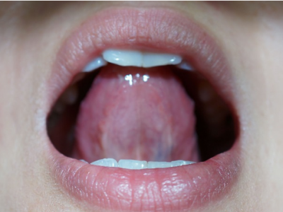 舌下腺って何？舌下腺にしこりがあるときに疑うべき６つの病気