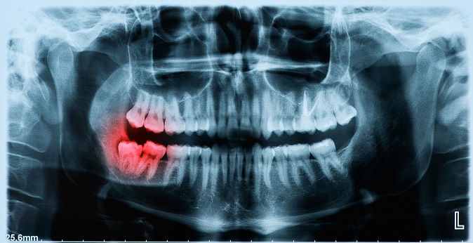 親知らず抜歯は年齢でリスクや痛みが違う！？年代別問題点まとめ。