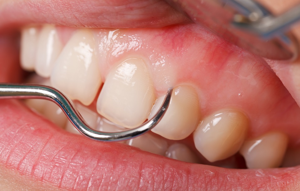歯茎が腫れて痛い時に考えられる５つの病気と、治療法・応急処置