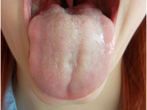 舌癌について総まとめ。早期発見・見分けるために13の症状チェック