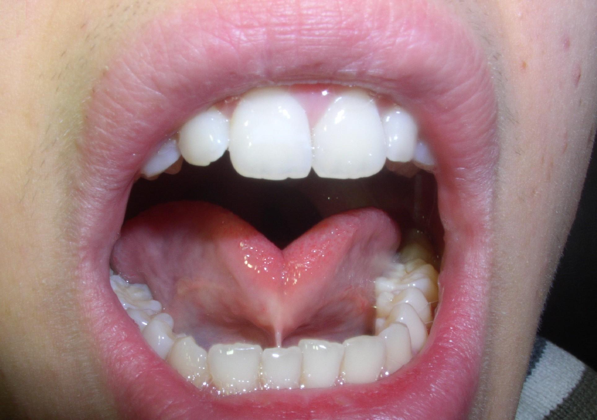 舌癒着症が赤ちゃんに与える影響と、９つの症状チェック！
