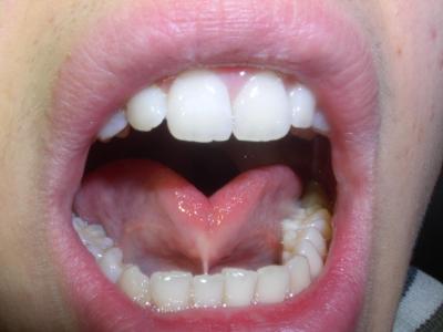 舌癒着症が赤ちゃんに与える影響と、９つの症状チェック！