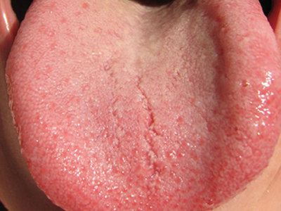 舌乳頭って何？役割と種類、起こりやすい病気について