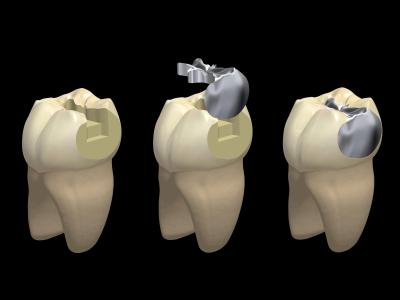 歯の根っこを手術（歯根端切除術）が必要になった場合、あなたの虫歯はかなり進んでいます。