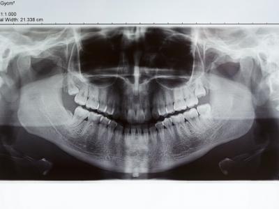 金属アレルギーの症状は銀歯でも起こる！症状や対策について。