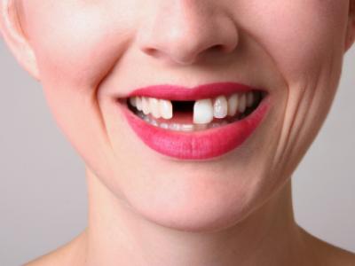 2人に1人が歯で苦しむ未来が待ち受ける。30代の50％が抜けた歯を放置している異常な状況に。