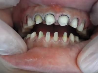 若者に大人気の歯列矯正がアナタの歯をボロボロにする。歯科医はオススメしないセラミック矯正の闇
