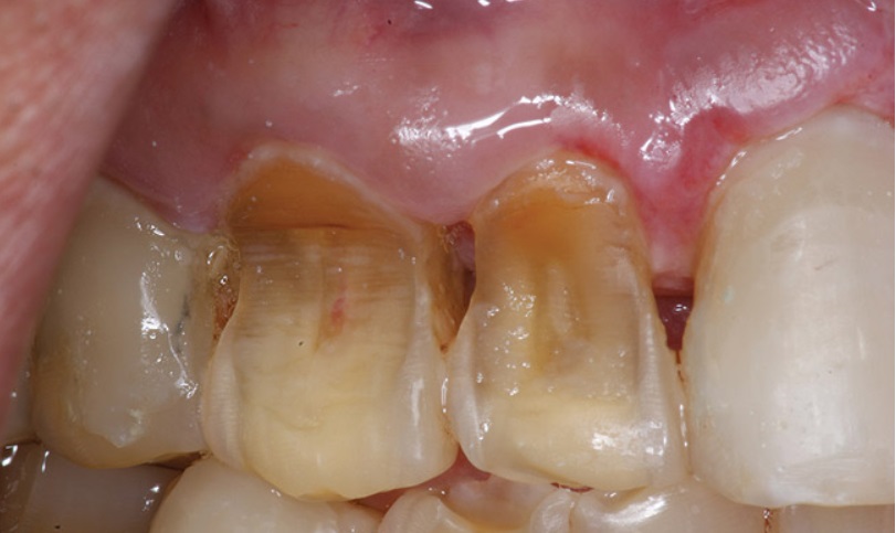 健康ドリンクがアナタの歯をボロボロにする。虫歯だけじゃない、アナタの歯を溶かす怖すぎる病気