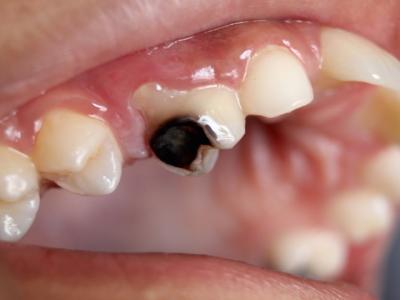 虫歯が臭い、臭い汁が出ているというアナタの歯、あと数年で１４本なくなります。