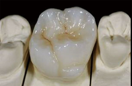 歯医者さんが本当にしたいむし歯の処置は銀歯では不可能。今高額なセラミックが歯科医から選ばれる理由