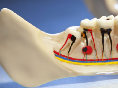 歯の神経除去（根管治療）は難易度が高い。繰り返します、歯の神経除去は難しいんです！