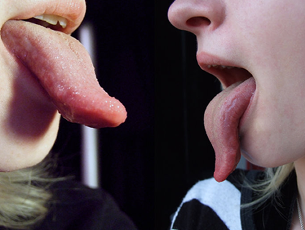 舌がヒリヒリする原因と対策が３分でわかります！