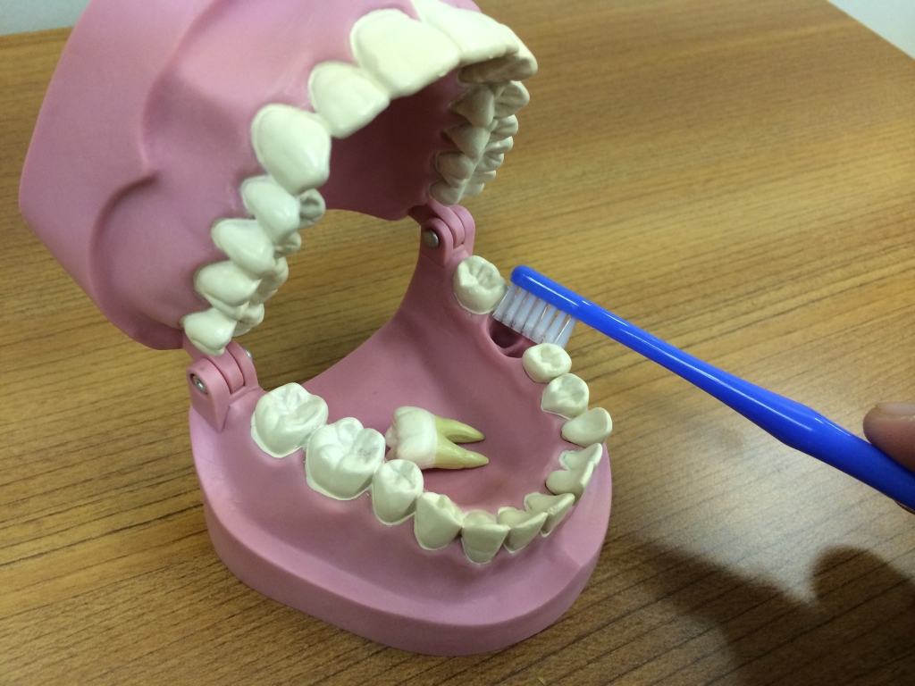 抜歯後の歯磨きテクニックと抜歯後に注意すべきこと！