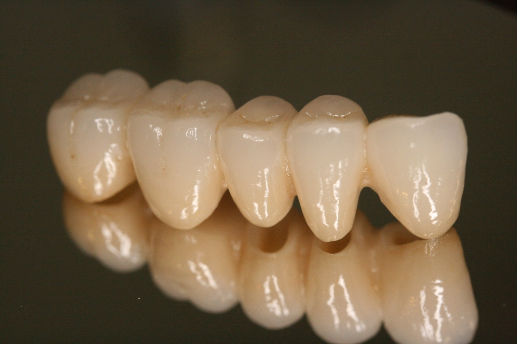 歯にブリッジをセラミックで入れることのメリット・デメリットをわかりやすく解説