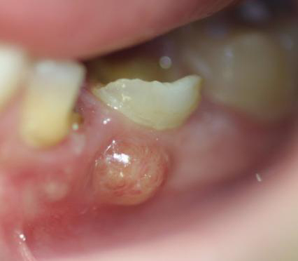 歯の膿