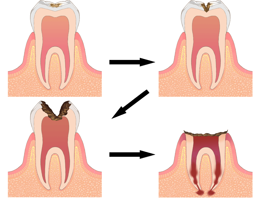 虫歯放置