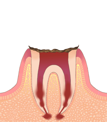 虫歯放置