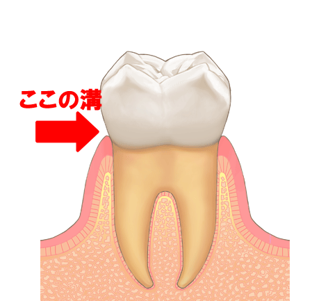 歯周病　ブラッシング