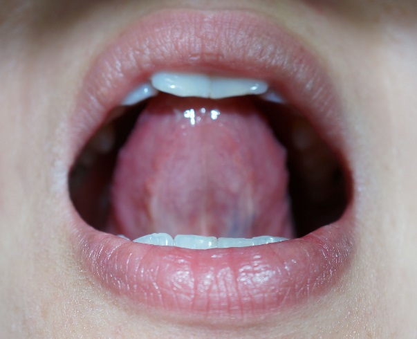 舌　しびれ