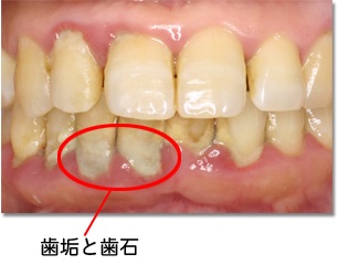 歯垢と歯石