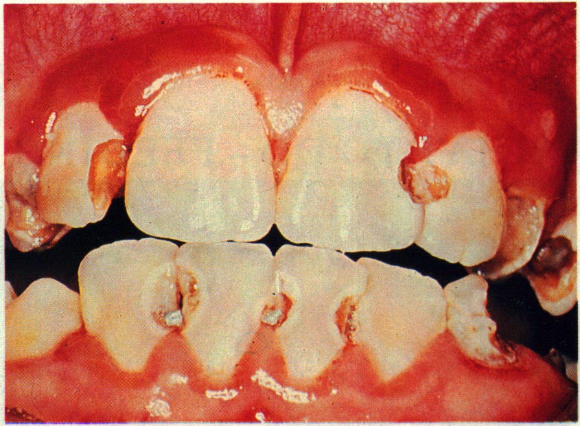 酸蝕歯　酸蝕症